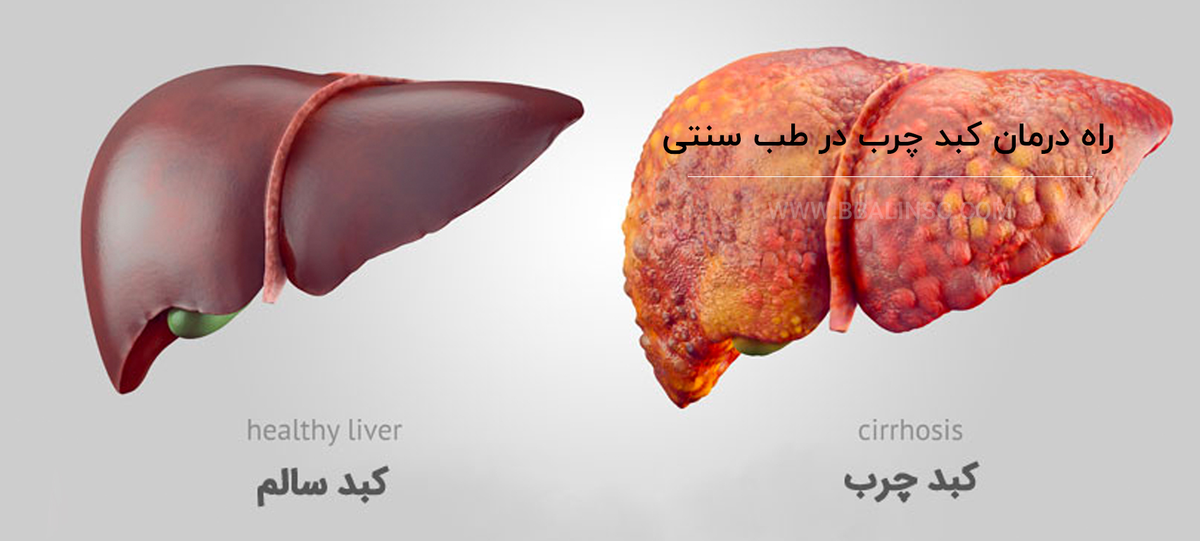 راه درمان کبد چرب در طب سنتی